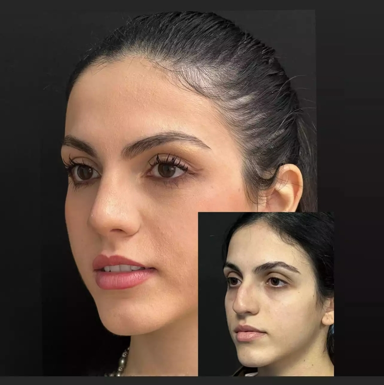 Rhinoplasty in Dubai: Combining Aesthetic Perfection with Advanced Techniques